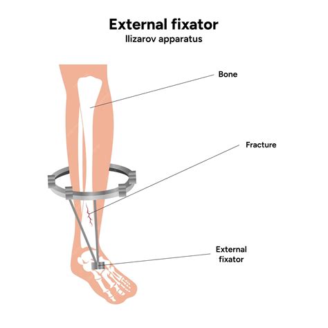 Premium Vector | External fixator llizarov apparatus