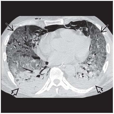 Noncardiogenic Pulmonary Edema | Radiology Key