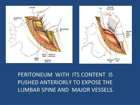 Retroperitoneal Approach To The Lumbar Spine1