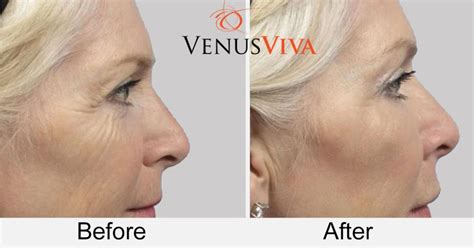 Venus Vina Nano Fractional Bionome Health Club