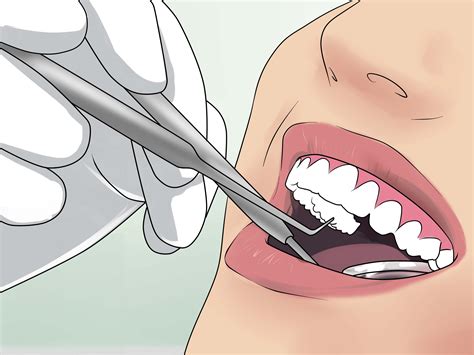 How To Clean Partially Erupted Wisdom Teeth 12 Steps