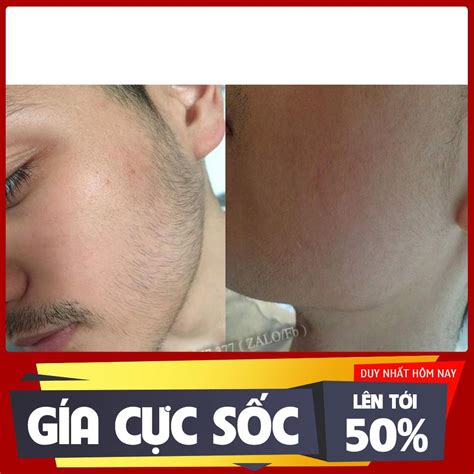 Minoxidil 5 Kirkland Chính Hãng Thuốc Mọc Râu Tóc Trị Hói Dưỡng