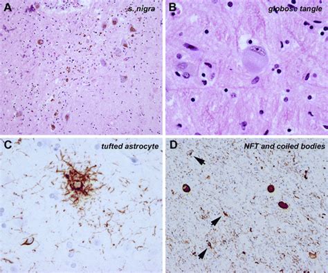 Characteristic Neuropathological Features Of Psp A Prominent Loss Of