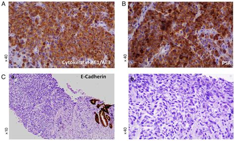 Patient With Prostatic Adenocarcinoma With Plasmacytoid Features And An