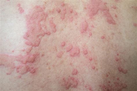 Hiv Rash Chest