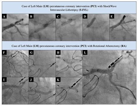 Intravascular Lithotripsy As A Novel Treatment Method For Calcified