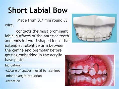 Labial Bows Ppt