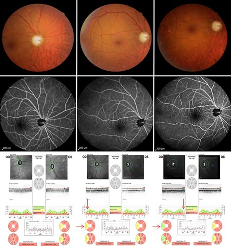 Color Fundus Images Top Retina Fluorescein Angiography Middle And Download Scientific