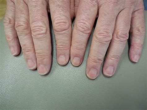 Polydactylous Transverse Erythronychia Report Of A Patient With Multiple Horizontal Red Bands