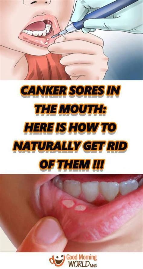 Canker Sores In The Mouth Here Is How To Naturally Get Rid Of Them Oralcare Canker Sore