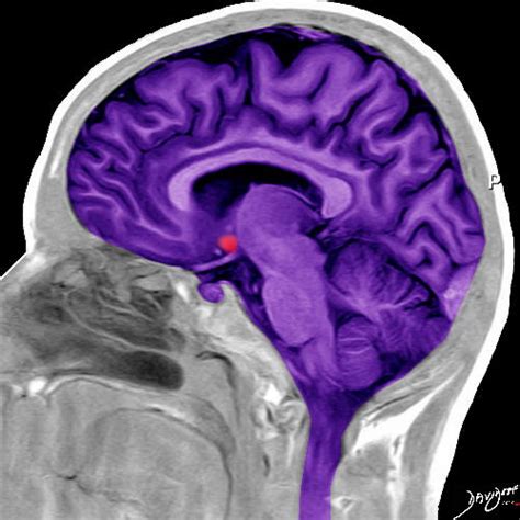 MRI Side View of the Brain in Purple | Art In Anatomy