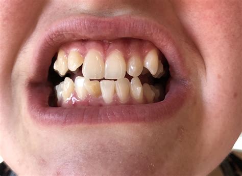 Second day of Invisalign and my teeth HURT. I know the pain will pass