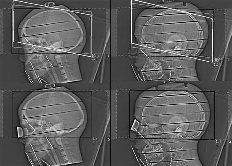 Lens Dose In Routine Head Ct Comparison Of Different Optimization