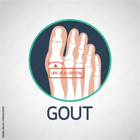 Gout vector logo icon illustration Stock Vector | Adobe Stock