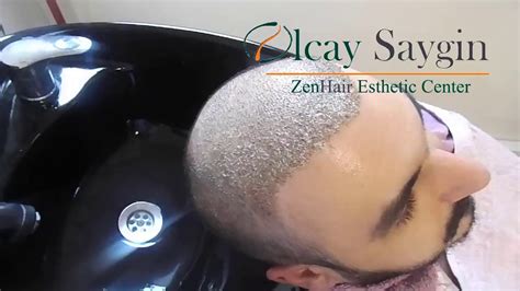 How To Do The Nine Hair Wash After Hair Transplant Removing Scabs