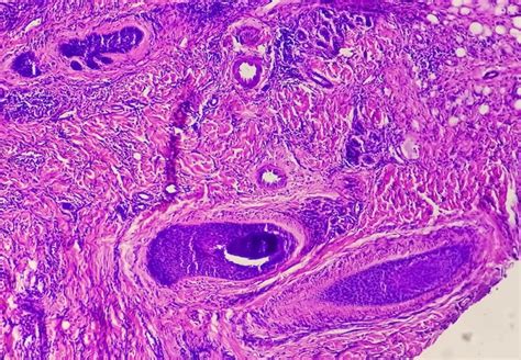 La Vista Microscópica Del Carcinoma Basocelular Es Un Tipo De Cáncer De