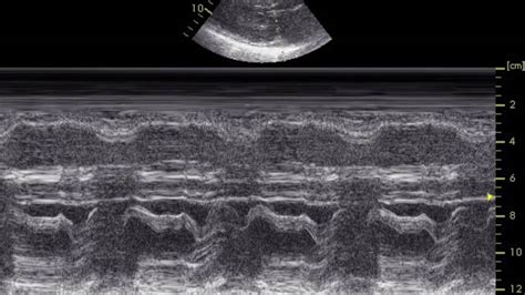 Alexandru Mischie Obstructive Hypertrophic Cardiomyopathy With Sam