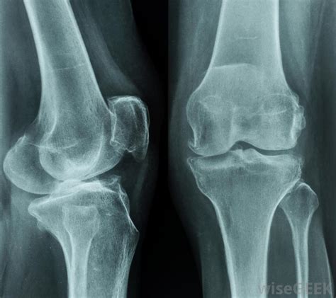 X Ray Knee Injury