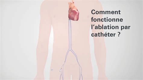 L ablation par cathéter Tout savoir sur la FA