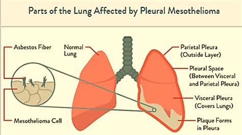 pleural mesothelioma - wikitechy