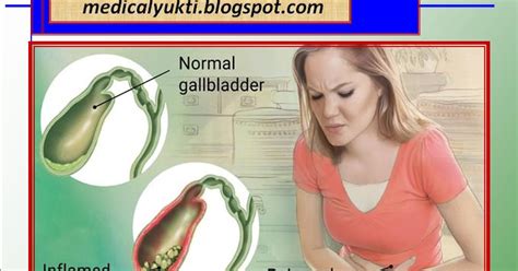 Cholecystitis Medical Yukti