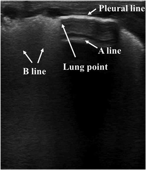 Pneumothorax On Lung Ultrasonography Lung Point The Transition From