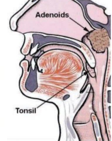 enlarged adenoids  tonsils primitive breathing