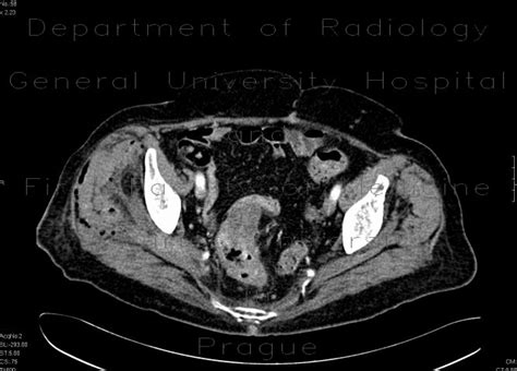 Radiology Case Necrotic Tumor Of Rectosigmoid Junction Fistulisation Into Thigh