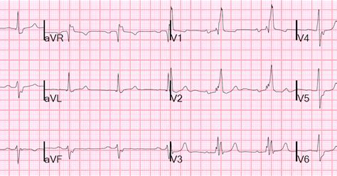 Dr. Smith's ECG Blog: Right Bundle Branch Block. What else?