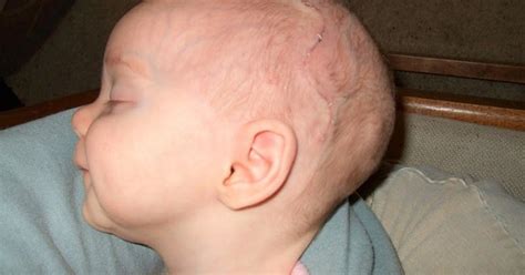 Scaphocephaly: What is it? Symptoms, Causes, Diagnosis and Treatment ...