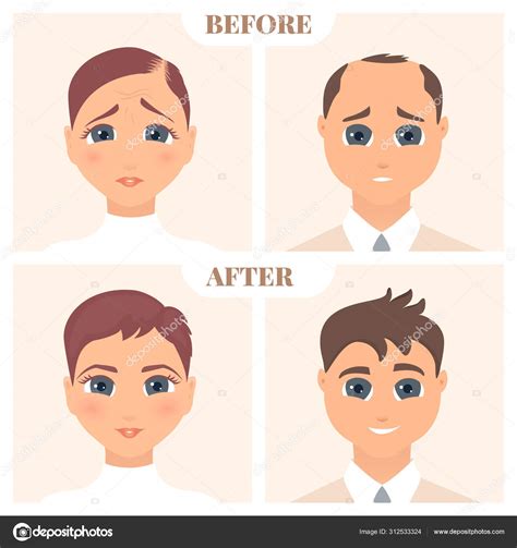 Female and male pattern alopecia set. Medical educational poster. Stock