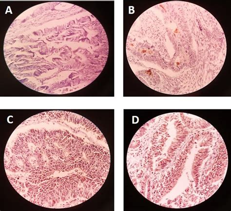 Evaluation Of Cd133 Expression By Immunohistochemical Method A No