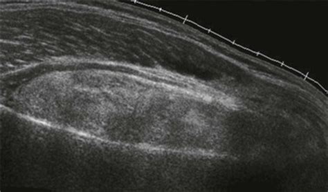 Ultrasound of Soft Tissue Masses | Radiology Key