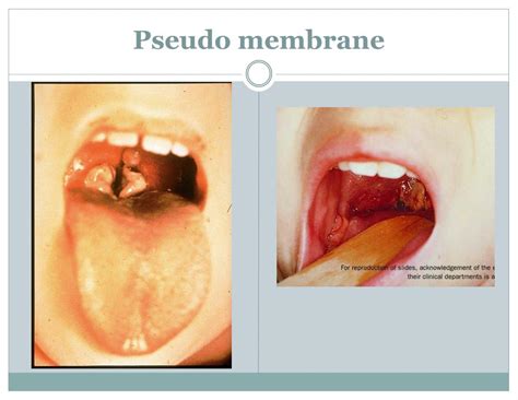 PPT - Diphtheria PowerPoint Presentation, free download - ID:260231