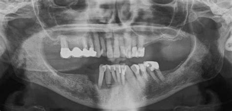 135 Surgical Resection Of Cancer Of The Buccal Mucosa Medicine