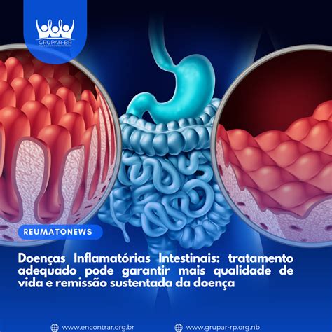 Doenças Inflamatórias Intestinais tratamento adequado pode garantir