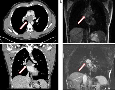 Bronchogenic Cyst Ultrasound