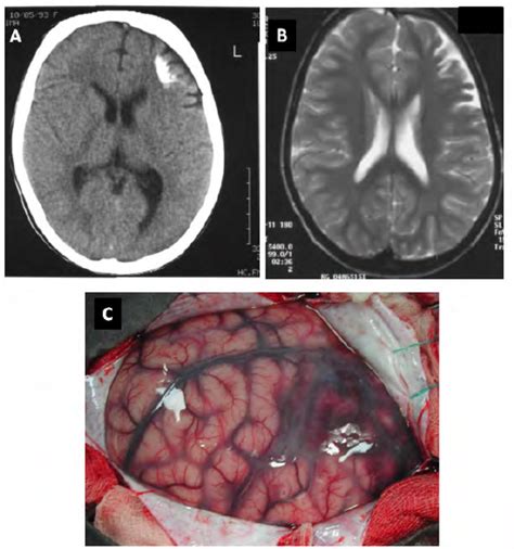 Frontal lobe lesion of Sturge-Weber syndrome. A. Computerized... | Download Scientific Diagram