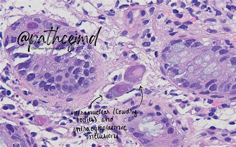 Case 7: CMV Colitis