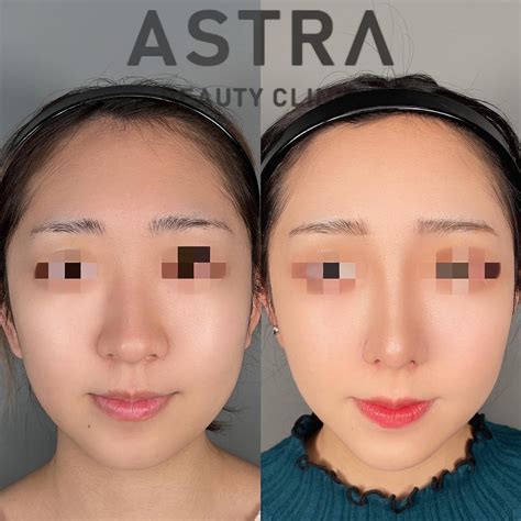 鼻尖形成小鼻縮小軟骨移植隆鼻術脂肪注入 【公式】astra Beauty Clinic（アストラビューティクリニック）｜美容外科