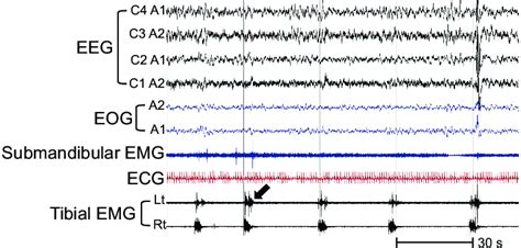 Polysomnogram From A Patient With Periodic Limb Movements During Sleep Download Scientific