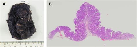 Colorectal Endoscopic Submucosal Dissection Technical Advantages