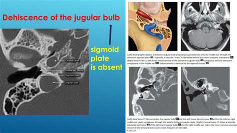 Ppt Jugular Bulb Abnormalities Powerpoint Presentation Free Download