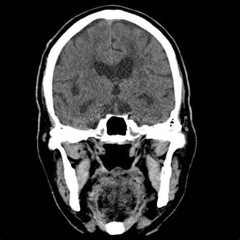 Ruptured Intracranial Dermoid Cyst Image