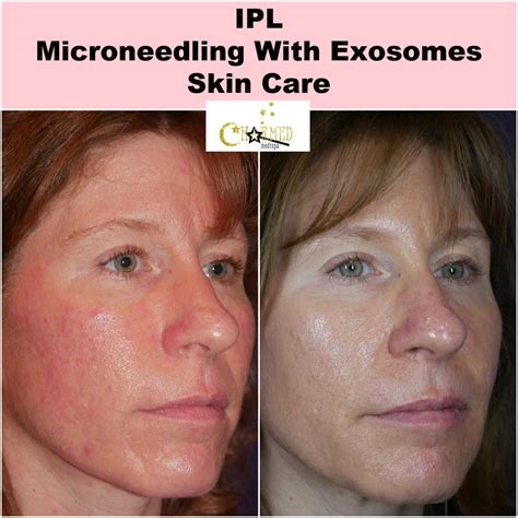 Rejuvenating Your Skin The Power Of Ipl And Microneedling With