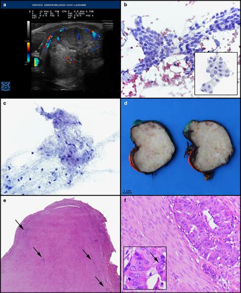 Papillary Thyroid Carcinoma With Nodular Fasciitis Like Stroma And