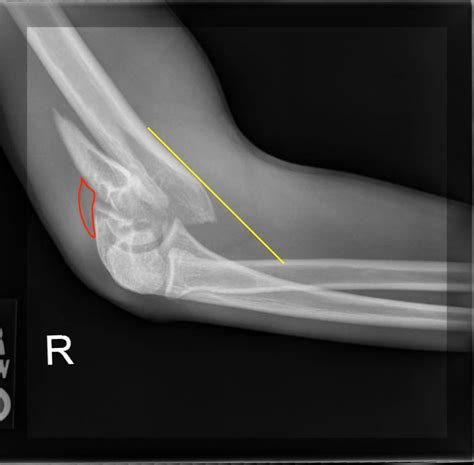 Supracondylar Fracture Lateral Xr Annotated Jetem 2017 Jetem