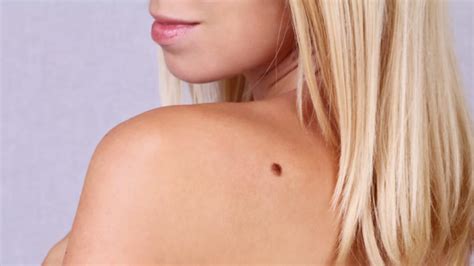 Why Does Hair On Moles Grow More Quickly Mental Floss