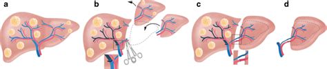 The Rapid Approach Combines Resection With Partial Liver Segment 2 3