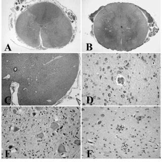 Neuropathological Findings A Transverse Section Of The Spinal Cord At